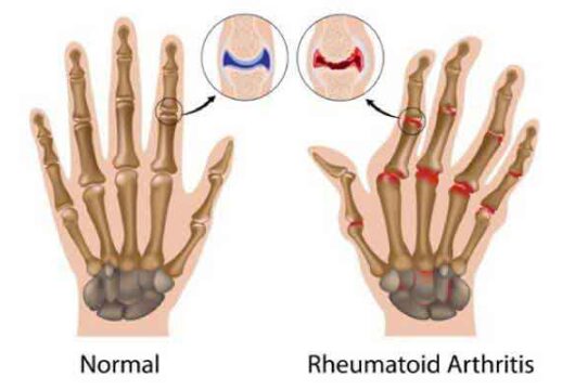Finger Joint Pain – Symptoms, Causes, Treatments & More