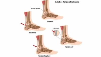 The #17 Natural Home Remedies For Tendonitis