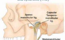 #5 Things You Must Know About Temporomandibular Joint Disorder