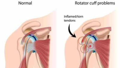 Rotator Cuff Tears – What are the Symptoms of Rotator Cuff Tears?
