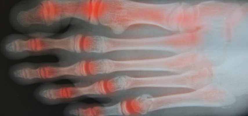 5 Easy & Effective Strategies to Manage Arthritis Joint Pain