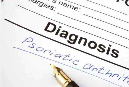 Psoriatic Arthritis: Read The Types, Symptoms, Causes, & Treatments