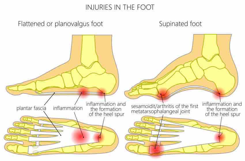Everything You Need To Know About Cavus Foot